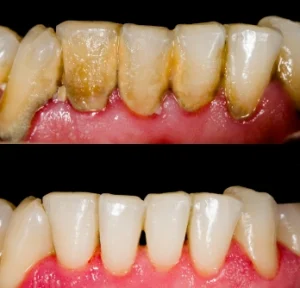 ขูดหินปูน