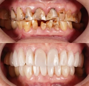 เปรียบเทียบรอยยิ้มดาราก่อนและหลังทำวีเนียร์