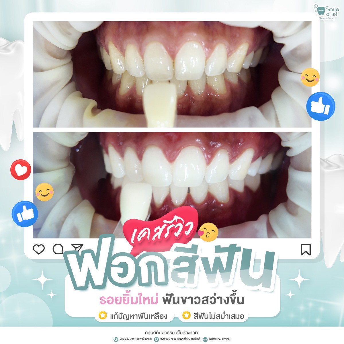 ฟอกสีฟัน